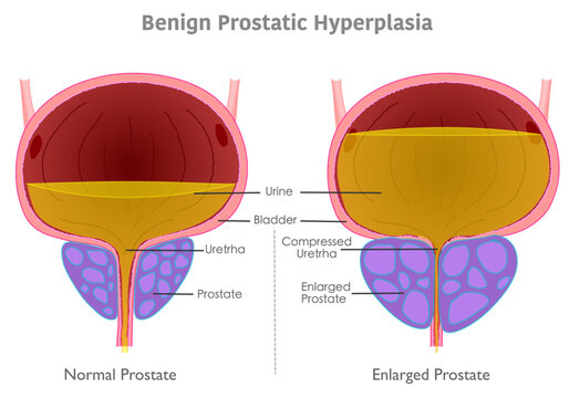 Benign prostatic hyperplasia anatomy. Enlarged, normal prostate, cancer, BPH. Compressed bladder glans, urinate pee flow. Medical illustration vector