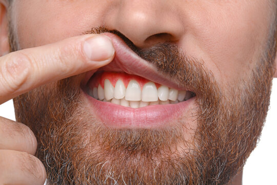 Man showing inflamed gum, closeup. Oral cavity health