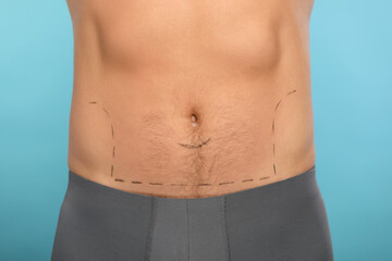 Fototapeta na wymiar Man with markings on belly before cosmetic surgery operation on light blue background, closeup