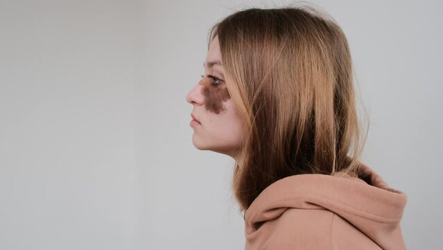 Portrait of teenager young woman with large birthmark taking off hood of beige sweatshirt silhouette. Girl demonstrates her peculiarity of otherness diversity copy space