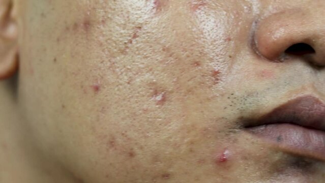 skin problems. Close up of Inflamed acne problem on Asian man face, swelling, redness, and pores badly blocked by bacteria, oil, and dead skin cells.