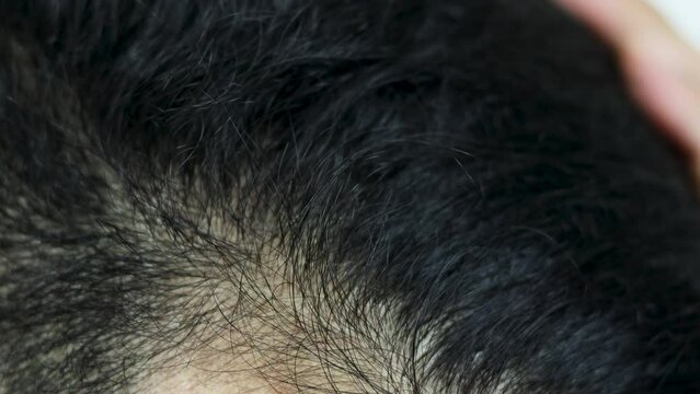 Close Up Young people have problems with hair loss, dryness, dullness, split ends and damage.