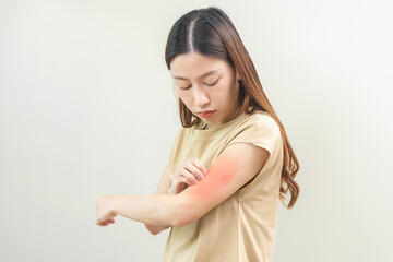 Obraz premium Dermatology asian young woman, girl allergy, allergic reaction from atopic, insect bites on her arm, hand in scratching itchy, itch red spot or rash of skin. Healthcare, treatment of beauty.