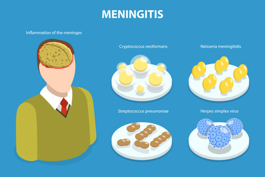 3D Isometric Flat Vector Illustration of Meningitis, Meningococcal Disease, Dangerous Meninges Inflammation