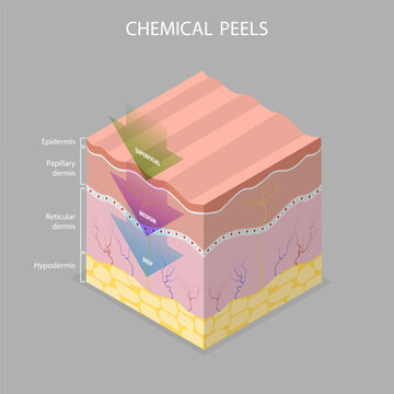 3D Isometric Flat Vector Illustration of Skin Chemical Peel, Beauty Aesthetic Treatment