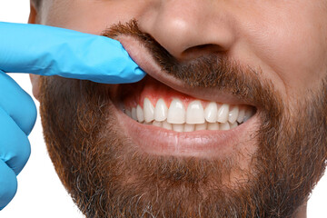 Doctor examining man's inflamed gum on white background, closeup