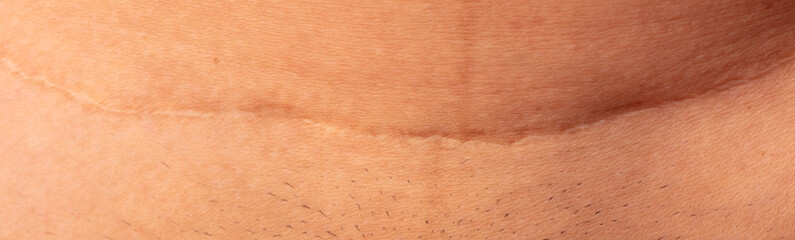 Scar on human skin after caesarean section