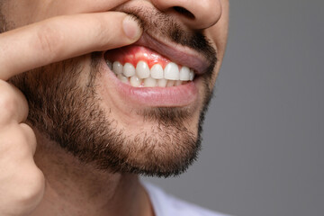 Man showing inflamed gum on grey background, closeup. Space for text - obrazy, fototapety, plakaty