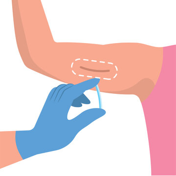 contraceptive implant birth control