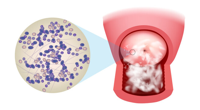 Illustration of a candidiasis infection on the cervix. Candida albicans this infection is also known as thrush (or moniliasis).Vaginal Candidiasis