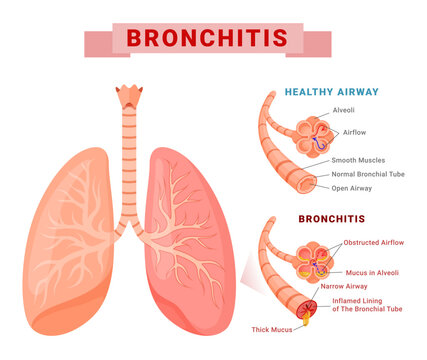 Bronchitis and healthy airway structure infographic medical education scheme banner isometric vector