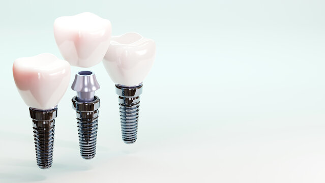 3D rendering of tooth implants with ceramic crowns on color background, Modern dental surgery concept