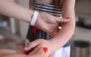 Fototapeta na wymiar Woman holding child hand with sunburn closeup. Protecting children skin from sunburn concept