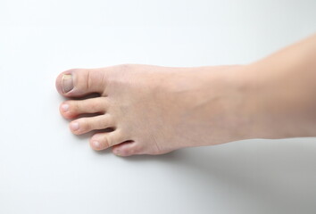 Womans leg with injured toe on white background. Diagnosis and treatment of nail fungus concept