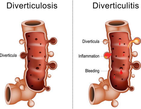 Difference between diverticulitis and diverticulosis