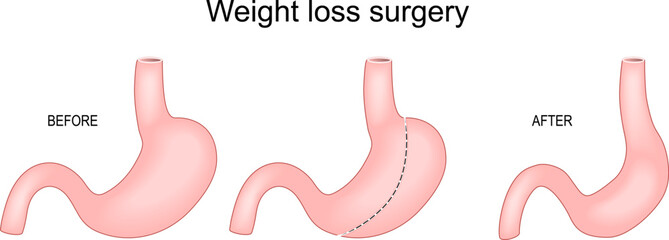 Weight loss surgery. Sleeve gastrectomy. Bariatric surgery.