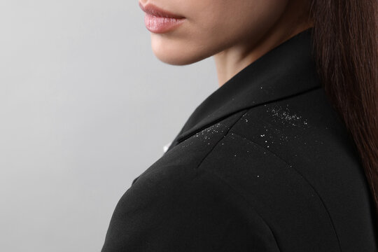 Woman with dandruff on her jacket against light grey background, closeup. Space for text