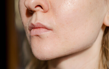 The woman skin flakes off at the mouth. Dry skin. Face skin irritation after peeling, after cold...