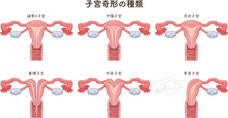 子宮奇形の種類・Uterine malformation - obrazy, fototapety, plakaty