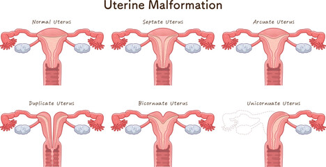 子宮奇形の種類・Uterine malformation - obrazy, fototapety, plakaty