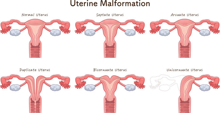 子宮奇形の種類・Uterine malformation