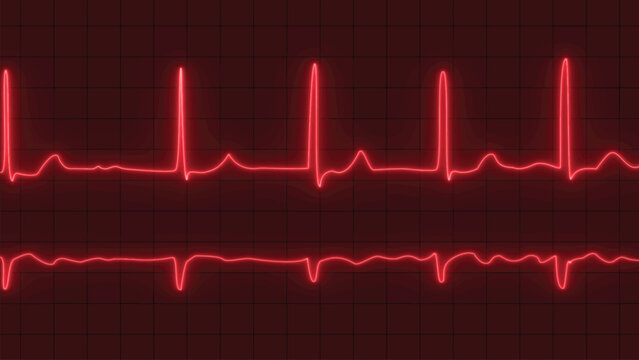 Atrial fibrillation vector. ECG or EKG pulse heartbeat red line fibrillation vector illustration. ECG with brief paroxysms of supraventricular extra systole and glowing atrial fibrillation vector.