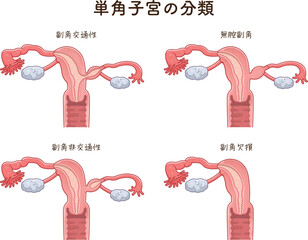 単角子宮の分類・Unicornuate uteru - obrazy, fototapety, plakaty