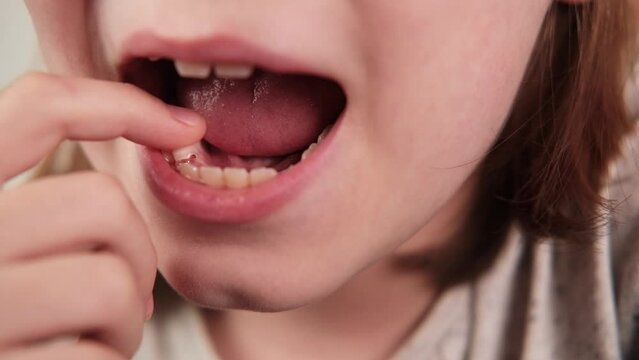 Close-up shot of a young boy's mouth as he wiggles his loose milk tooth