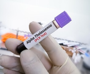 Blood sample in hematologist hand for Alpha Thalassemia PCR testing 