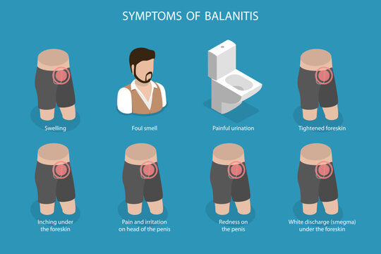 3D Isometric Flat Vector Illustration of Symptoms Of Balanitis, Inflammation of the Frenulum