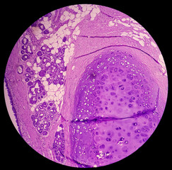 Thyroid cancer. Tracheal gland involved by tumor. Microscopic image of Metastatic papillary...