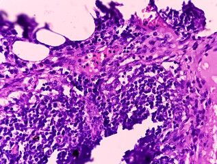 Thyroid cancer. Tracheal gland involved by tumor. Microscopic image of Metastatic papillary...