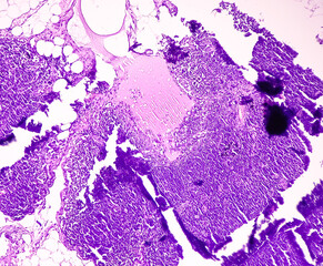 Thyroid cancer. Tracheal gland involved by tumor. Microscopic image of Metastatic papillary carcinoma of thyroid. Lymph node carcinoma.