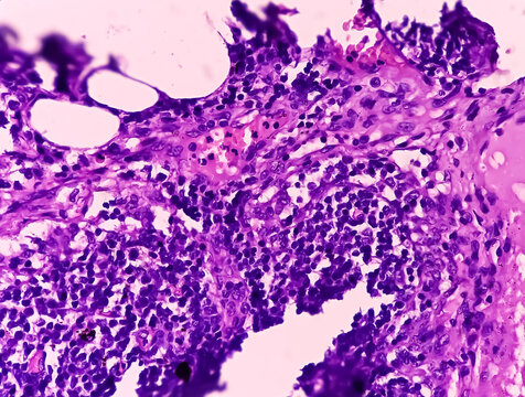 Thyroid cancer. Tracheal gland involved by tumor. Microscopic image of Metastatic papillary carcinoma of thyroid. Lymph node carcinoma.