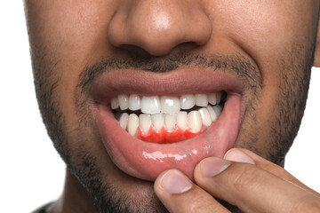 Man showing inflamed gum on white background, closeup