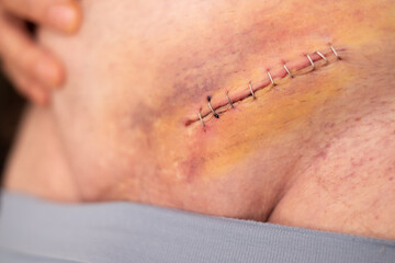 Nine staples to the groin scar on the body of an elderly gentleman after an inguinal hernia...