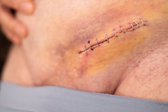 Nine staples to the groin scar on the body of an elderly gentleman after an inguinal hernia operation