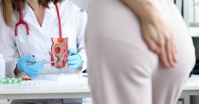The doctor holds an anatomical model of the anus with hemorrhoids, slow motion. Consultation with a proctologist surgeon