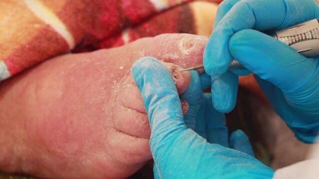 An orthopedist makes a pedicure to an elderly woman with sore nails using a special tool. onychodystrophy and dermatosis, close-up