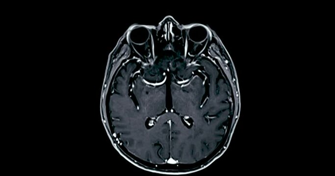 MRI Brain axial with gadolinium can help doctors look for conditions such as bleeding, swelling, tumors, infections, inflammation, damage from an injury or a stroke diseases.