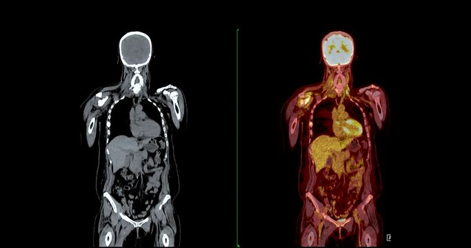 A PET-CT scan is a diagnostic imaging technique combining positron emission tomography (PET) and computed tomography (CT) in cancer diagnosis and staging. 