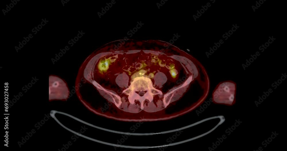 Poster a pet-ct scan is a diagnostic imaging technique combining positron emission tomography (pet) and com