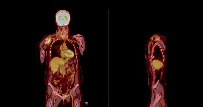 A PET-CT scan is a diagnostic imaging technique combining positron emission tomography (PET) and computed tomography (CT) in cancer diagnosis and staging. 