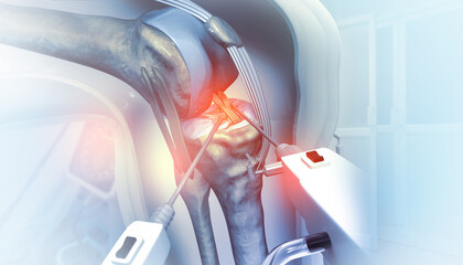 Human knee replacement surgery. Knee joint treatment. Knee injury. 3d illustration