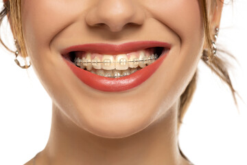 Obraz premium Braces. Orthodontic Treatment. Dental Care Concept. Closeup Ceramic and Metal Brackets on Teeth. Beautiful Female Smile with Braces. Beautiful Woman Healthy Smile close up on white background