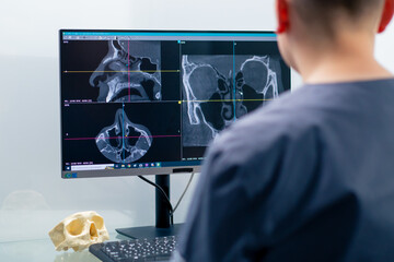 a radiologist doctor looks at a screen showing a 3D image of a nose scan to determine the results...