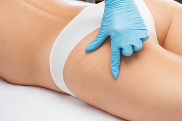 doctor shows  the dilation of small blood vessels of the skin on the leg. Medical inspection and...