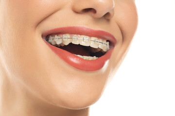 Braces. Orthodontic Treatment. Dental Care Concept.  Closeup Ceramic and Metal Brackets on Teeth. Beautiful Female Smile with Braces. Beautiful Woman Healthy Smile close up on white background