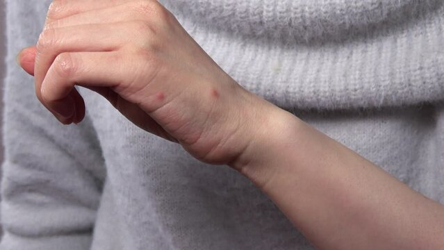 手の甲の複数の虫刺されの痕を見せる女性  4K  2023年12月11日