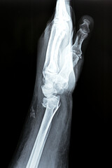 Colles' fracture of an old female, a type of fracture of the distal forearm in which the broken end...